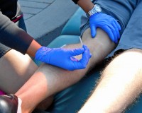 Trigger Point Dry Needling
